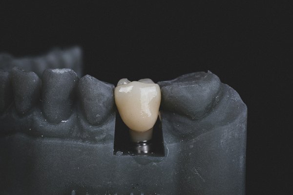 Implant dentaire : quels sont ses avantages ?