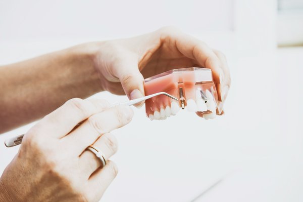 Implant dentaire : quand est-ce que l'implant intervient ?